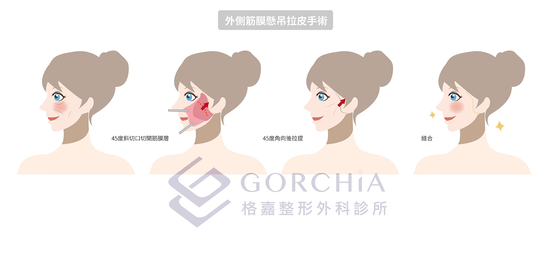 外側筋膜懸吊拉皮手術(lateral SMASectomy facelift)